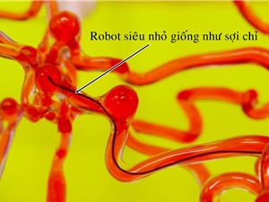 Robot siêu nhỏ giúp loại bỏ cục máu đông trong não