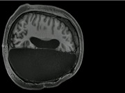 Nghiên cứu MRI tiết lộ cách một số người sống bình thường chỉ với... nửa bộ não