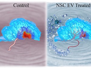 Exosome tiết từ tế bào gốc có thể điều trị đột quỵ