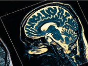 Điều trị Alzheimer bằng kỹ thuật siêu âm