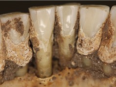 Cao răng tiết lộ thói quen dùng thuốc của người xưa