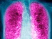 Xơ phổi: Bệnh hô hấp chết người ít ai biết 