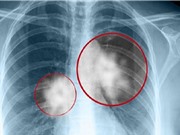 Chẩn đoán sớm bệnh bụi phổi silic nhờ các kỹ thuật tiên tiến