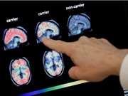 Thử nghiệm sử dụng trí tuệ nhân tạo để chẩn đoán sớm chứng sa sút trí tuệ