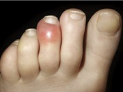 Hiện tượng “ngón chân COVID” có thật hay không?