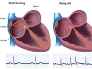 Dùng AI xác định cơn rung nhĩ từ máy đo tín hiệu điện tim cầm tay