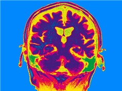 Kích thích điện vào não bộ giúp cải thiện trí nhớ 