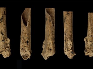 Ca phẫu thuật chi sớm nhất được thực hiện cách đây khoảng 31.000 năm