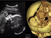 Ca phẫu thuật não đầu tiên trên thai nhi trong bụng mẹ