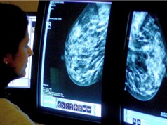 AI sàng lọc ung thư vú chính xác tương đương hai bác sĩ X quang