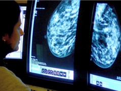 AI dự đoán tác dụng phụ sau điều trị ở bệnh nhân ung thư vú