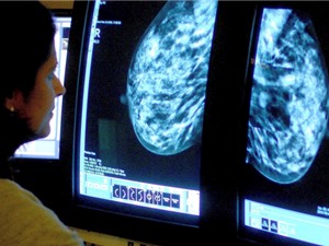 AI dự đoán tác dụng phụ sau điều trị ở bệnh nhân ung thư vú