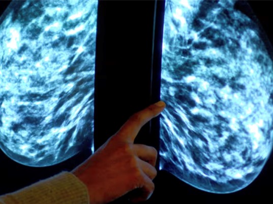 Thiết bị theo dõi ung thư vú gắn trong áo ngực