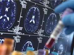 Neuralink thử nghiệm cấy ghép chip não cho bệnh nhân thứ hai