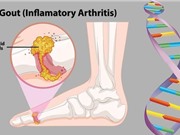 Yếu tố di truyền là tác nhân chính gây bệnh gút