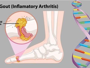 Yếu tố di truyền là tác nhân chính gây bệnh gút