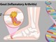 Yếu tố di truyền là tác nhân chính gây bệnh gút