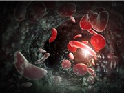 Phương pháp trị bệnh hồng cầu hình liềm mới