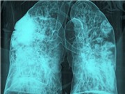 COVID và cúm có thể đánh thức tế bào ung thư ngủ yên trong phổi 