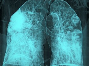 COVID và cúm có thể đánh thức tế bào ung thư ngủ yên trong phổi 