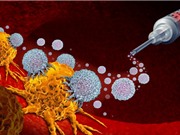 Vắc-xin ung thư mRNA hứa hẹn thay thế cho phẫu thuật, xạ trị và hóa trị