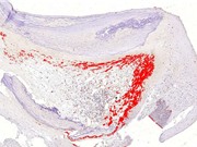 Vi khuẩn “ngủ” trong động mạch có thể kích hoạt các cơn đau tim