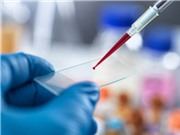 Xét nghiệm máu đầu tiên phát hiện chứng mệt mỏi mãn tính