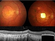 Người mù có thể đọc trở lại sau khi cấy ghép võng mạc