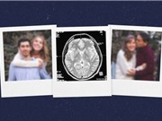 Vì sao những người mắc Alzheimer quên mất người thân?