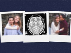 Vì sao những người mắc Alzheimer quên mất người thân?