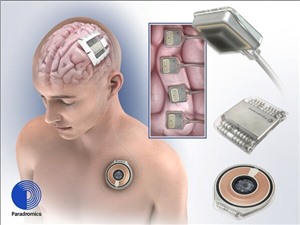 Thử nghiệm lâm sàng thiết bị cấy não giúp tạo ra giọng nói nhân tạo