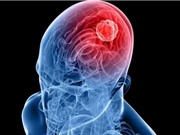 Hy vọng mới cho bệnh nhân mắc bệnh u nguyên bào thần kinh đệm
